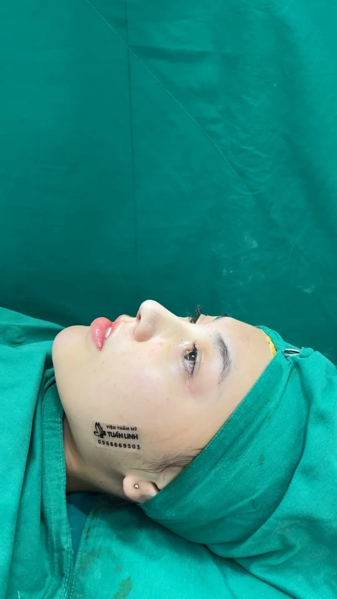Case Nâng mũi cấu trúc bọc Megaderm toàn sống hoàn thành sau 90 phút