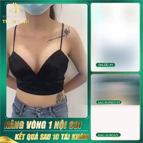 NÂNG V1 NỘI SOI - KẾT QUẢ SAU 10 NGÀY