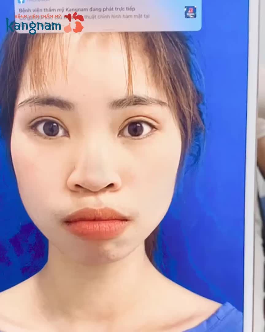 CHỈNH HÀM HÔ - Bác sĩ Kangnam vỡ òa vì gương mặt KH quá hoàn hảo