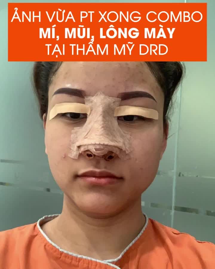 COMBO NÂNG MŨI + CẮT MÍ CÓ LÀM CHỊ EM XIÊU LÒNG