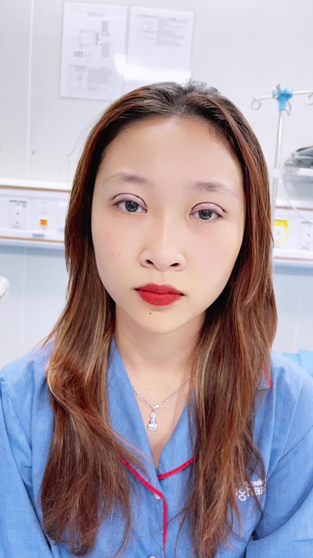 Kết quả Cắt mí trên Plasma Plus
