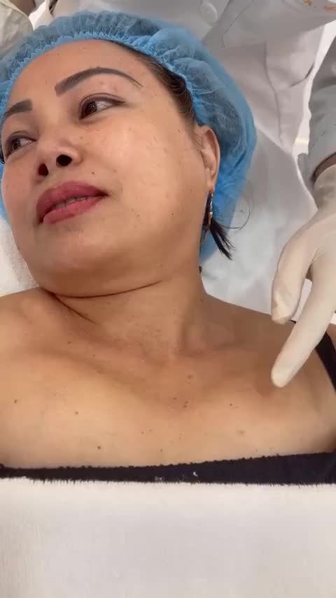Khách hàng với mụn thịt lây lan mất kiểm soát quanh mặt và cổ