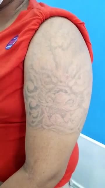 Xóa xăm sau liệu trình 6 buổi