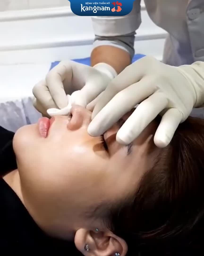 Cận cảnh dáng mũi sau 5 ngày nâng mũi 6D surgiform