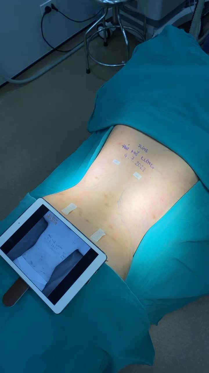 ĐIÊU KHẮC LƯNG THON VỚI VASER LIPO