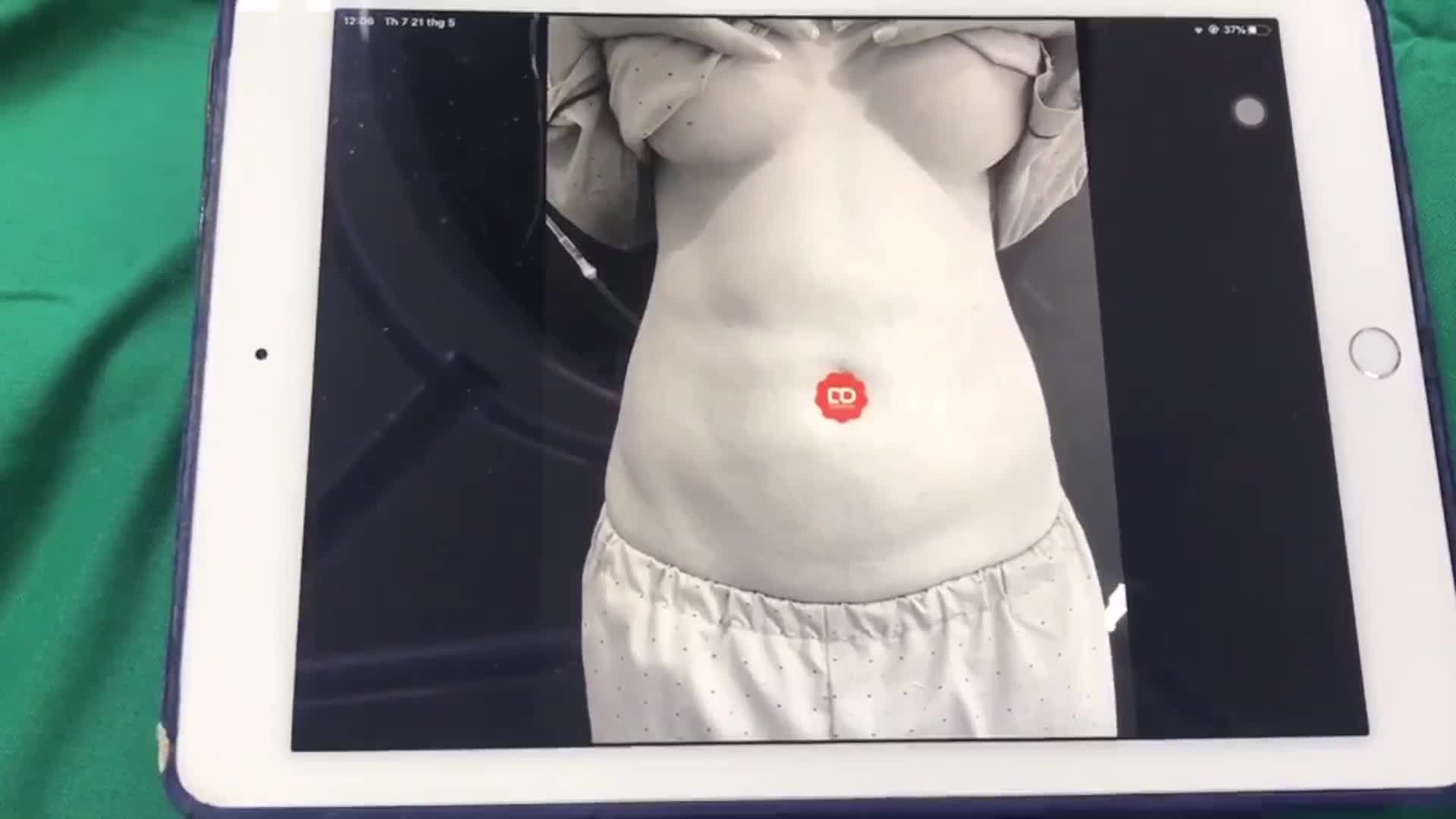 Kết quả ca HÚT MỠ VASER LIPO và CĂNG DA MINI vùng bụng đã có rồi đây cả nhà ơi.