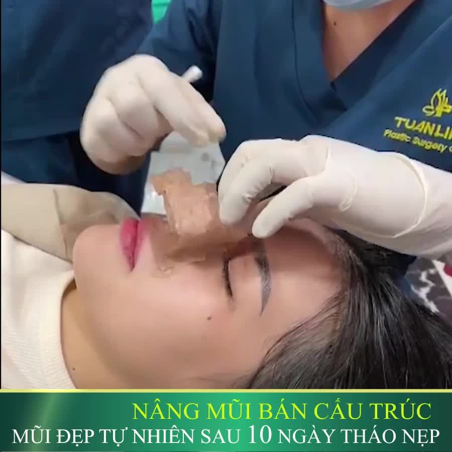 NÂNG MŨI BÁN CẤU TRÚC 25TR - TRẢ GÓP LÃI 0%