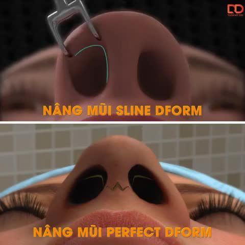 SỰ KHÁC NHAU CỦA NÂNG MŨI SLINE DFORM VÀ PERFECT DFORM