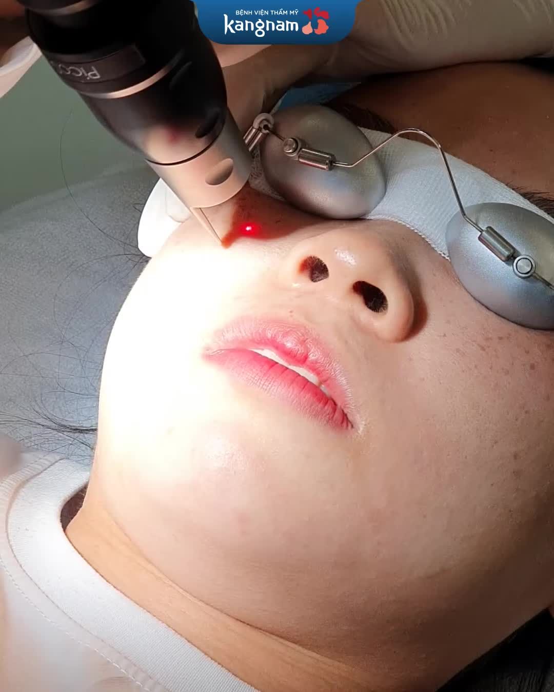Sau khi điều trị tàn nhang bằng Laser, dù ít hay nhiều làn da nhạy cảm vùng mặt đã bị tác động
