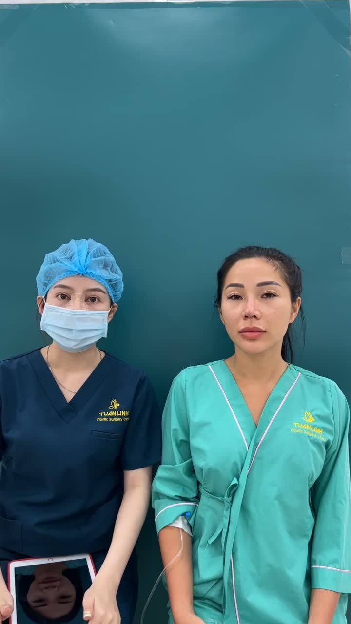 Tái tạo dáng mũi mới đẹp hoàn hảo cho chị gái đã từng nâng mũi Hàn Quốc cách đây 6 năm