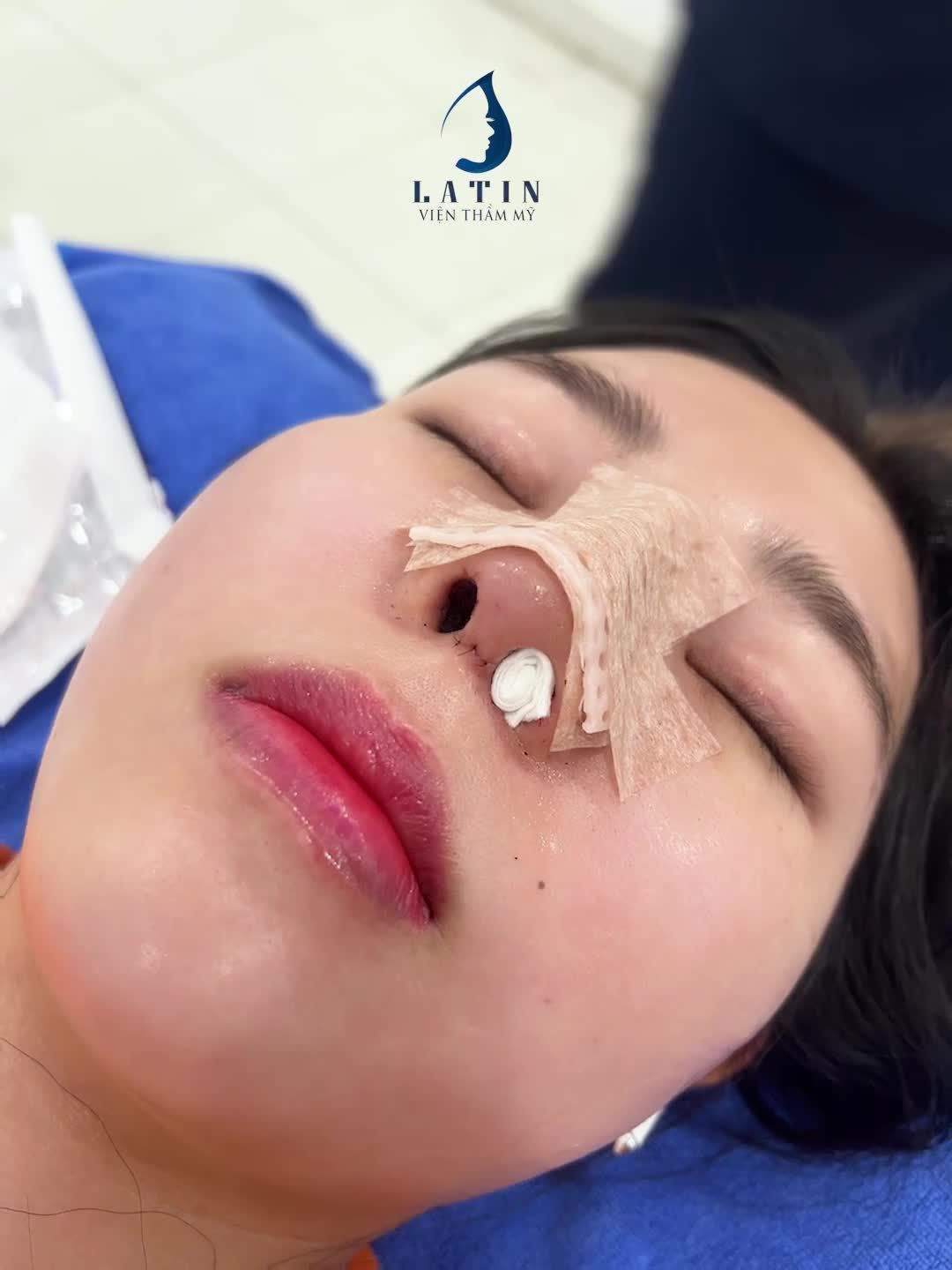 MŨI CẤU TRÚC CHỈ SAU 1 NGÀY