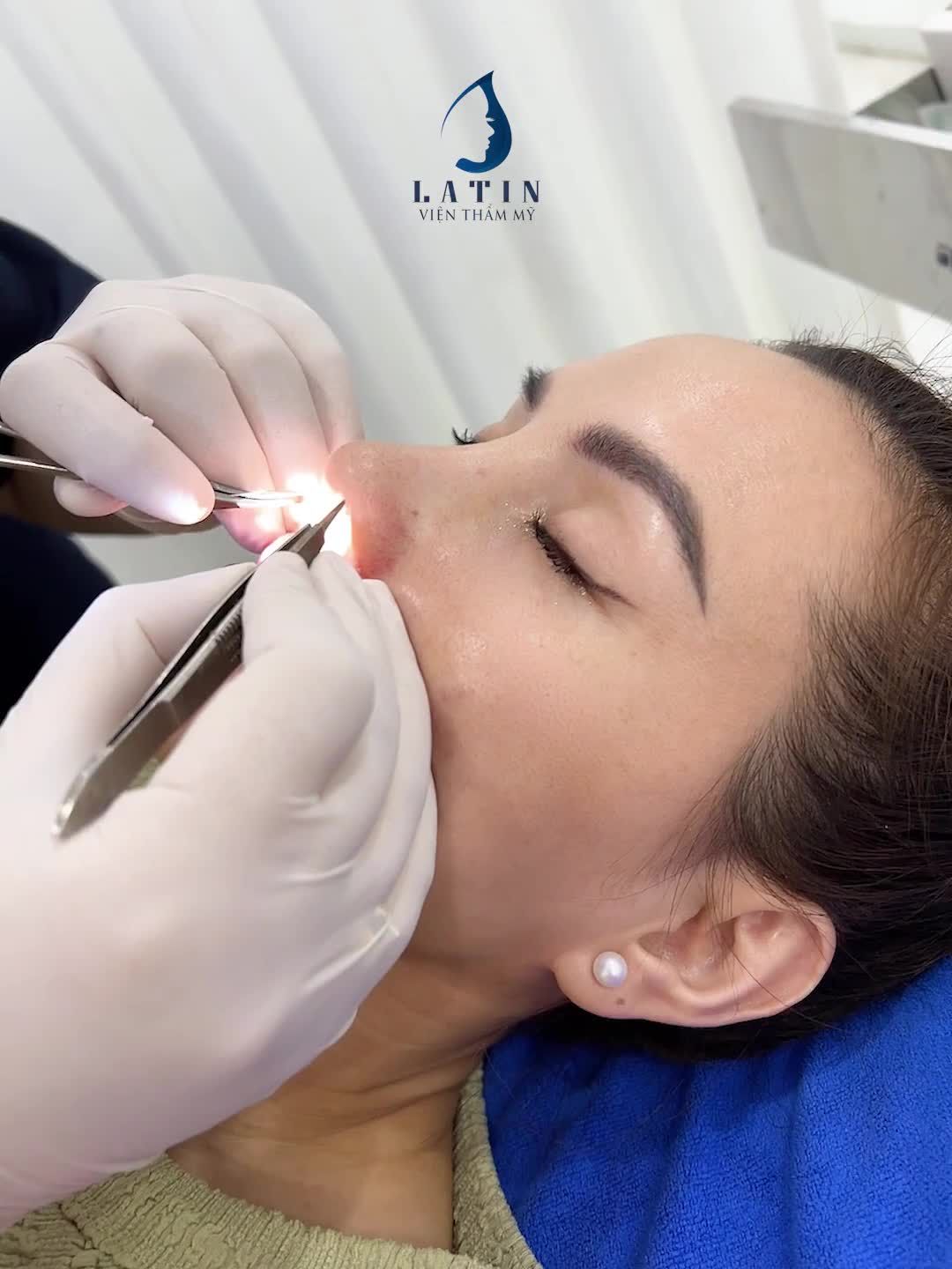 Tái khám sau 10 ngày mũi cấu trúc sụn sườn + độn cằm nội soi