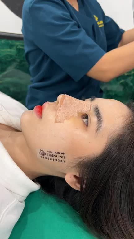 Thay nẹp sau 5 ngày nâng mũi bán cấu trúc