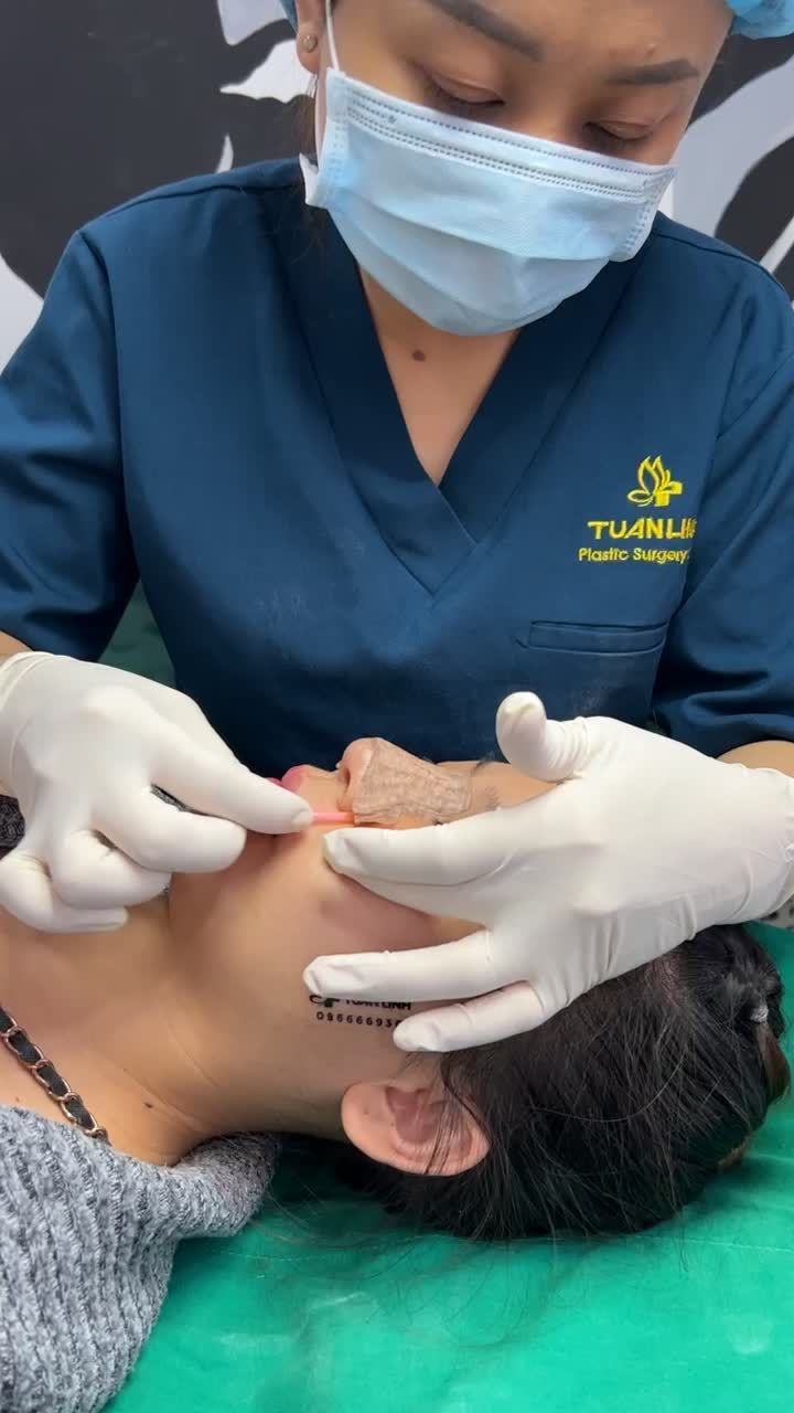Nâng mũi bán cấu trúc - Kết quả sau 10 ngày tháo nẹp, cắt chỉ, tái khám