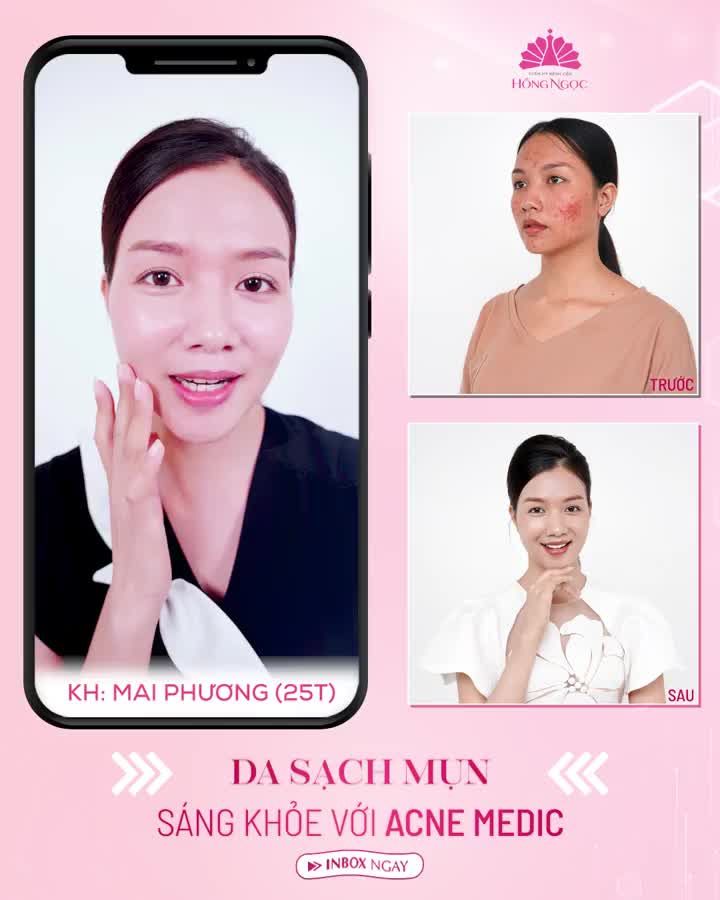MỤN VIÊM MỤN BỌC MỤN TRỨNG CÁ GIẢI QUYẾT TRIỆT ĐỂ CHỈ SAU 1 LIỆU TRÌNH