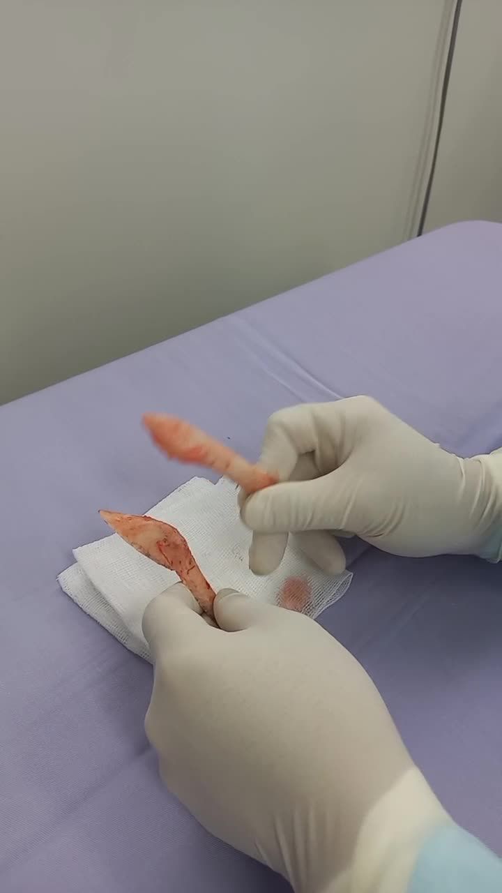 Xương hàm cắt ra sau phẫu thuật gọt hàm