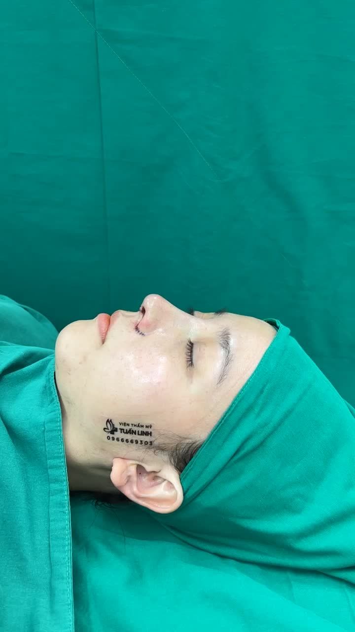 Case nâng mũi siêu cấu trúc sụn Surgiform + cuộn cánh vừa hoàn thành sau 90 phút