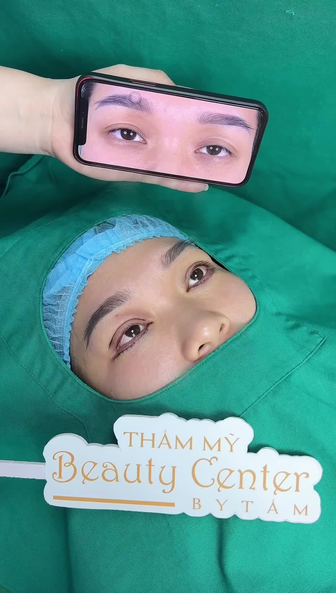 Cắt mí trên + dưới loại bỏ da chùng, nếp mí phụ. Kết hợp cùng cấy mỡ hốc mắt giúp phần mí hết lờ đờ mệt mỏi.