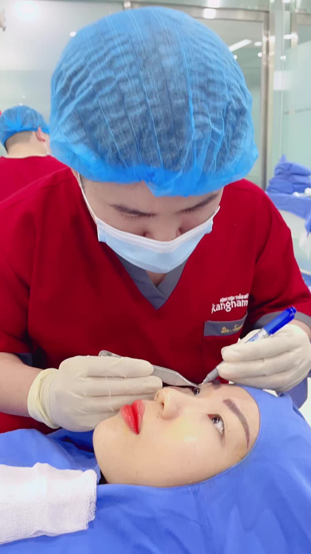 Ca phẫu thuật cắt mí trên Plasma 6D kết hợp Tạo khoé mắt trong