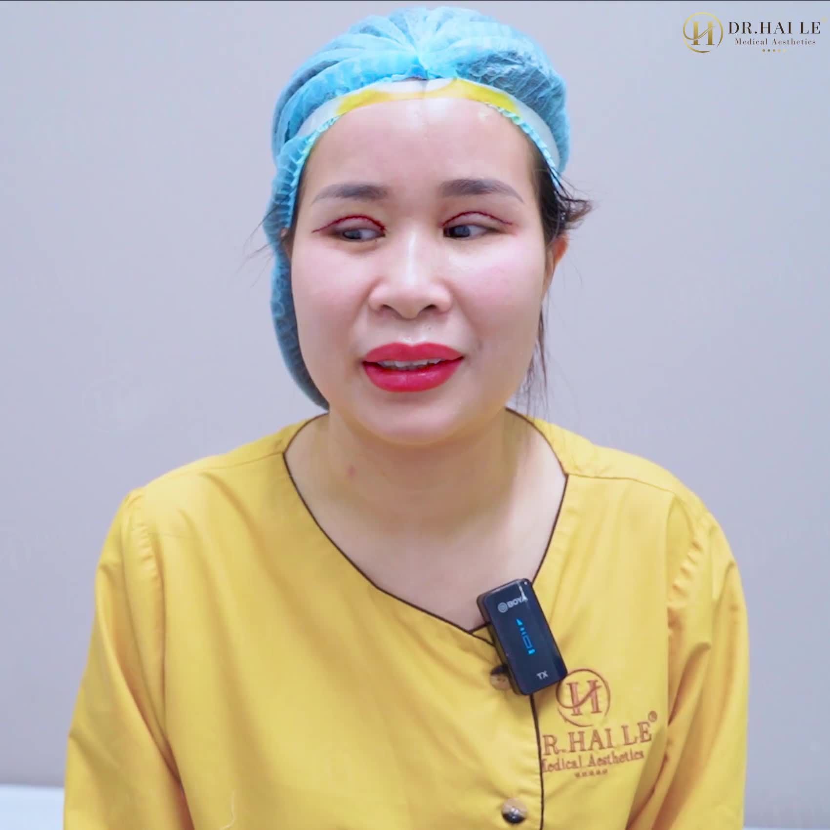 2 lần cắt mí hỏng tại cơ sở khác... VÀ CÁI KẾT SHOCK tại Dr.Hải Lê