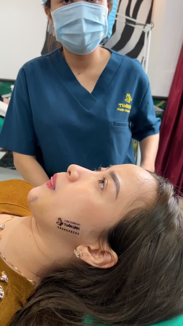 Case Cấy mỡ má tự thân - Tái khám sau 7 ngày.