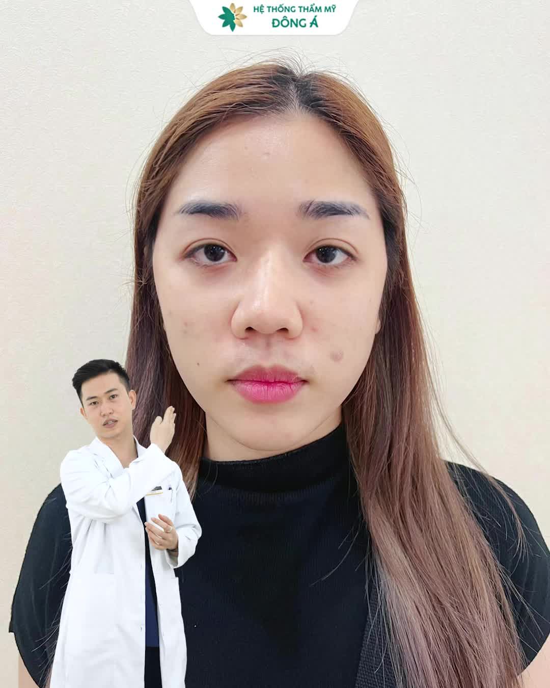 Rãnh cười sâu “Râu rồng” in đậm