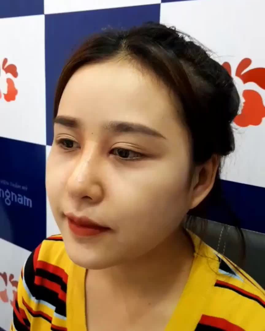Siêu phẩm nâng mũi kết hợp chỉnh xương! Xinh quá trời