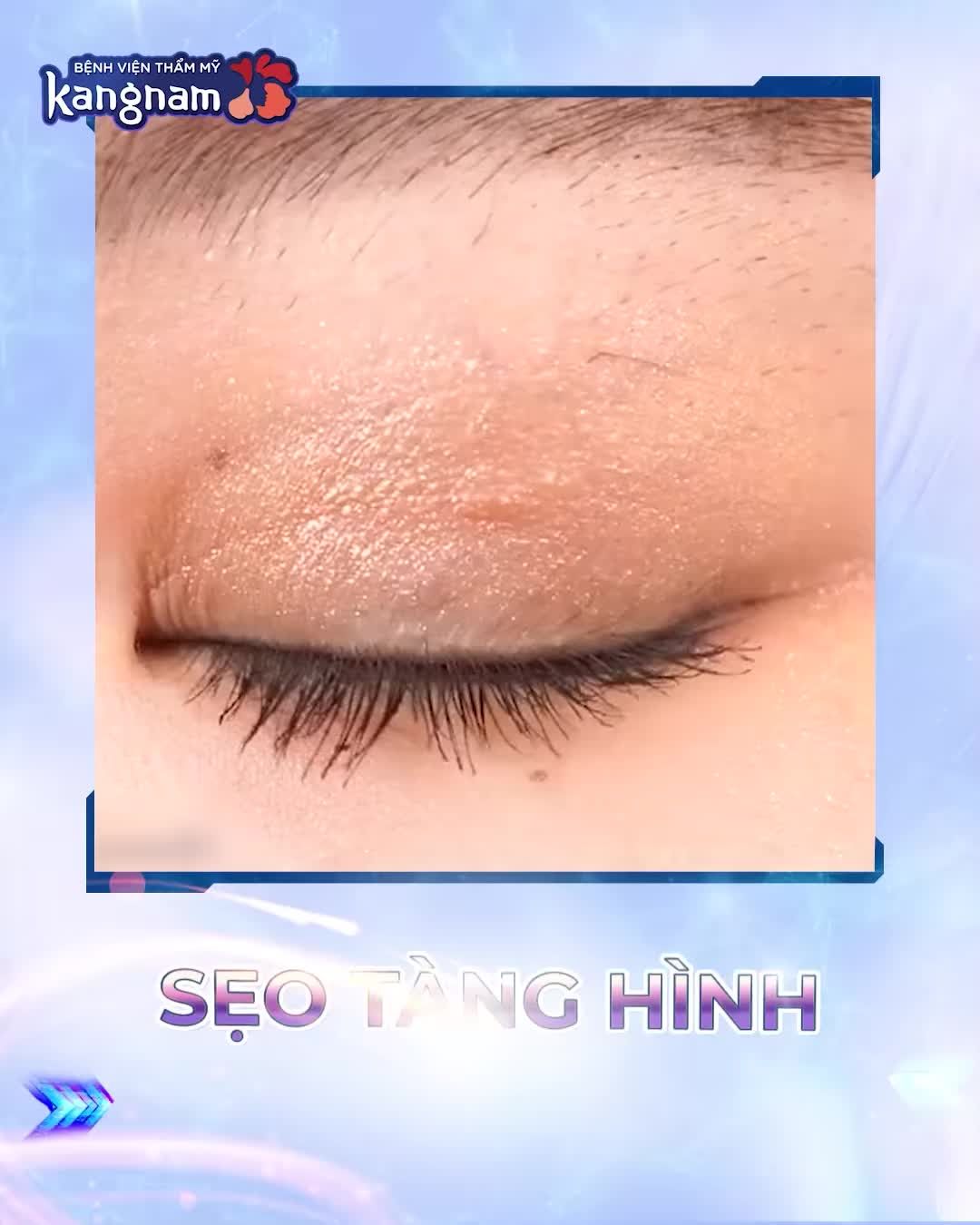 MỚI Đột phá công nghệ - Ra mắt Cắt mí Plasma Plus