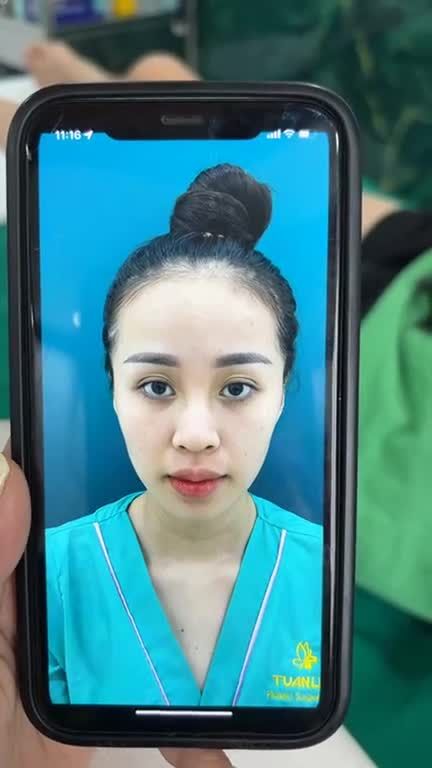 Nâng mũi bán cấu trúc sau 3 tháng tái khám