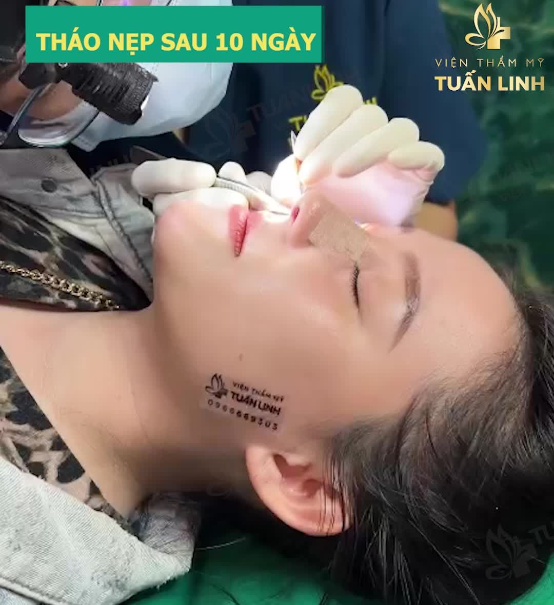 NÂNG MŨI SIÊU CẤU TRÚC - KẾT QUẢ SAU 10 NGÀY TÁI KHÁM