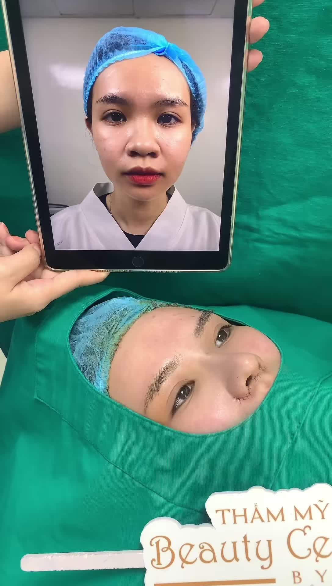 Kết quả ngay sau Nâng mũi Surgiform + Thu gọn cánh mũi