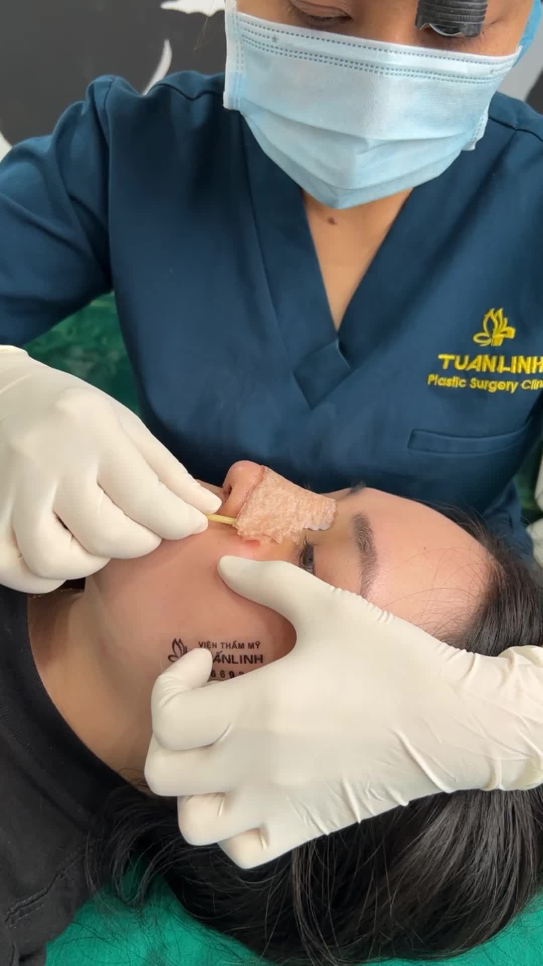 Kết quả sau 10 ngày nâng mũi cấu trúc!!!