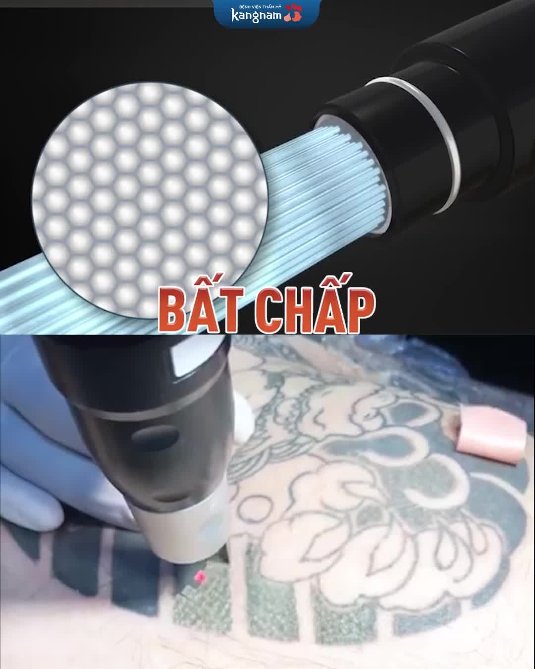 Laser Picosure - Xóa bật mọi gốc xăm