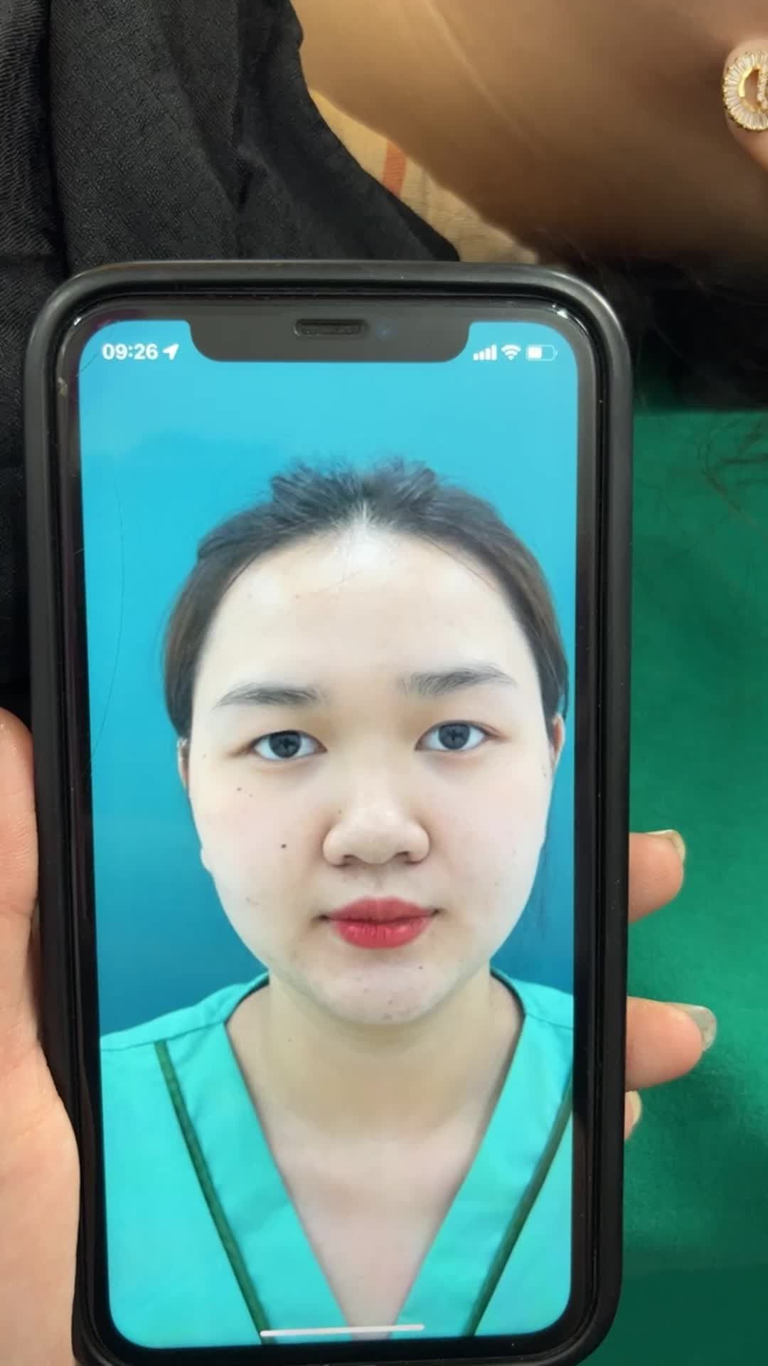 Mũi và mí sau 1 tháng sẽ vào phom như thế nào
