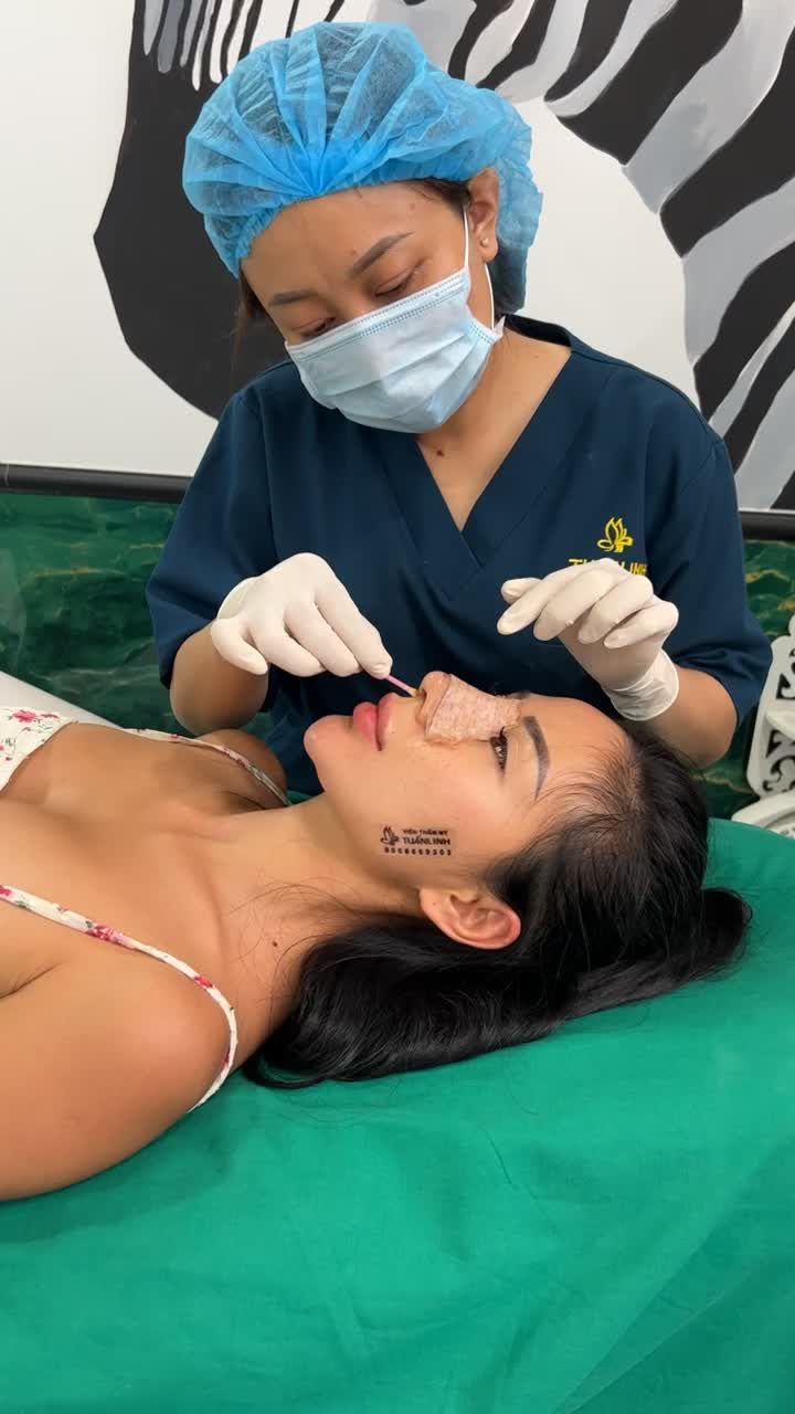 Cận cảnh phom mũi sau 5 ngày thay nẹp!!!