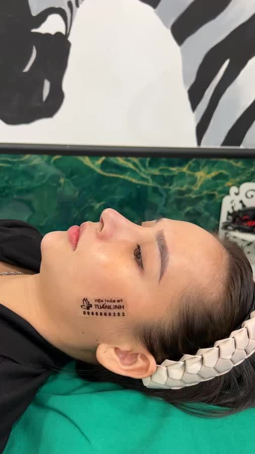 Khách hàng nâng mũi được 10 ngày với phương pháp cấu trúc sụn surgiform