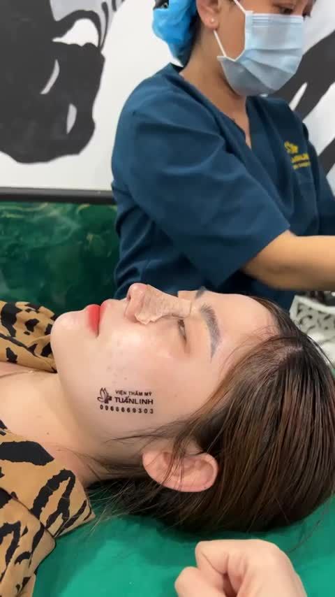 Mũi cấu trúc surgiform được 10 ngày - Khách hàng đến viện để tháo nẹp, cắt chỉ
