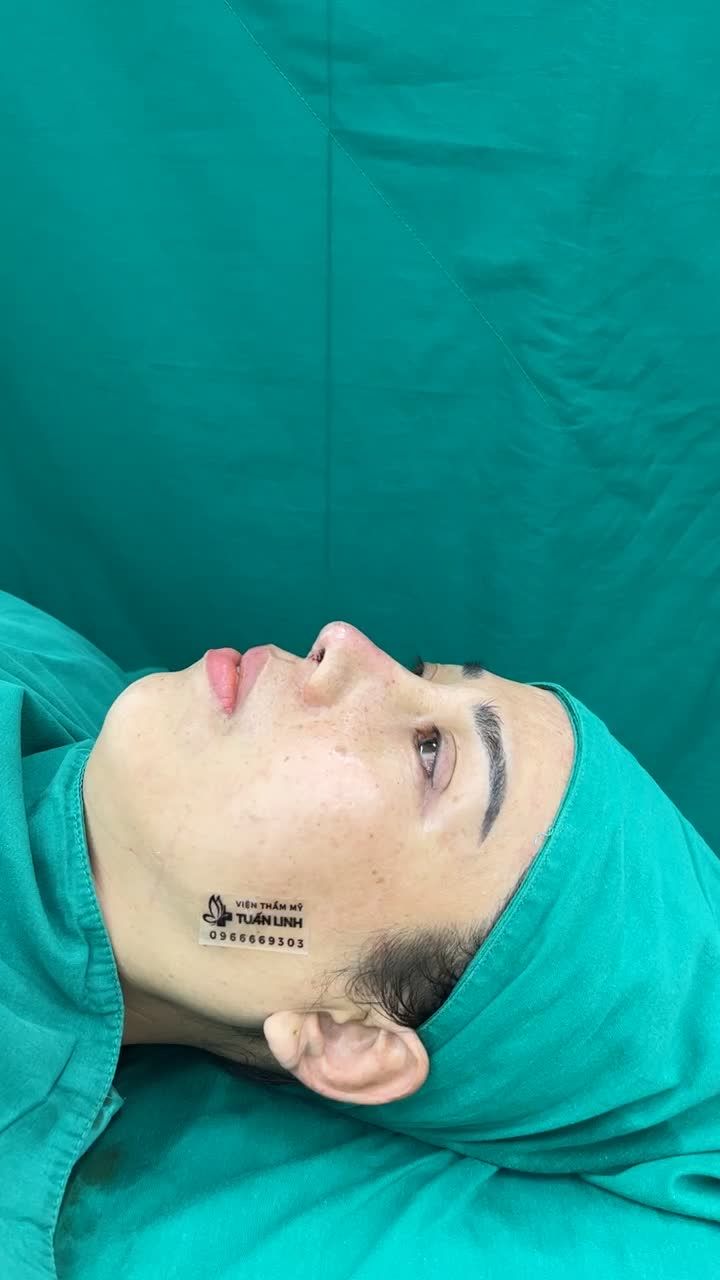 Case mũi Siêu cấu trúc sửa lại cho chị gái thích cao tây đầu mũi bay