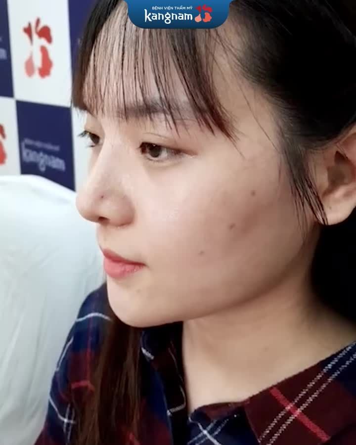Xem ngay dáng mũi sau 10 ngày nâng mũi 6D không đau