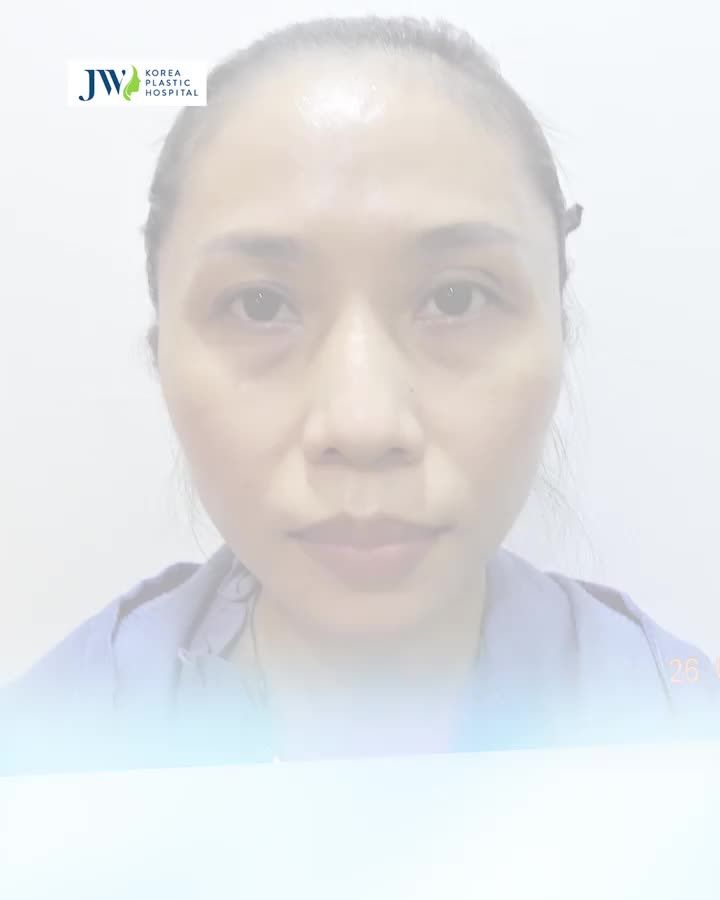 CẢI LÃO GƯƠNG MẶT 3M - TRẺ 30 TUỔI DỄ ẸC