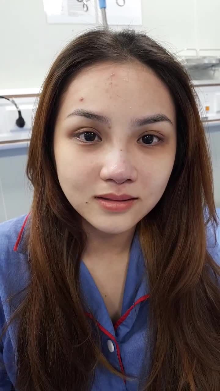 Xinh ngất ngây mọi góc nhìn với Nâng mũi 6D không đau nhà Kangnam