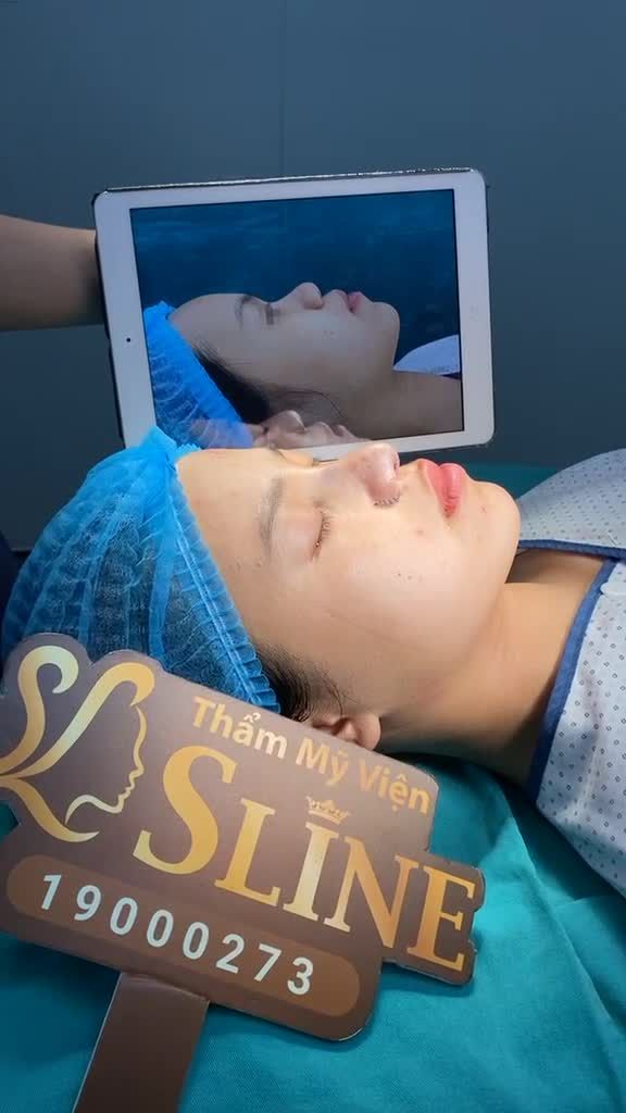 KẾT QUẢ NÂNG MŨI SLINE + CUỘN CÁNH MŨI
