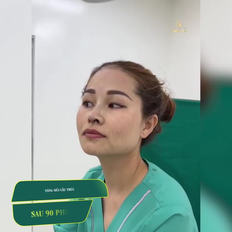 NÂNG MŨI ĐÃ THAY ĐỔI KHUÔN MẶT BẠN NHƯ THẾ NÀO