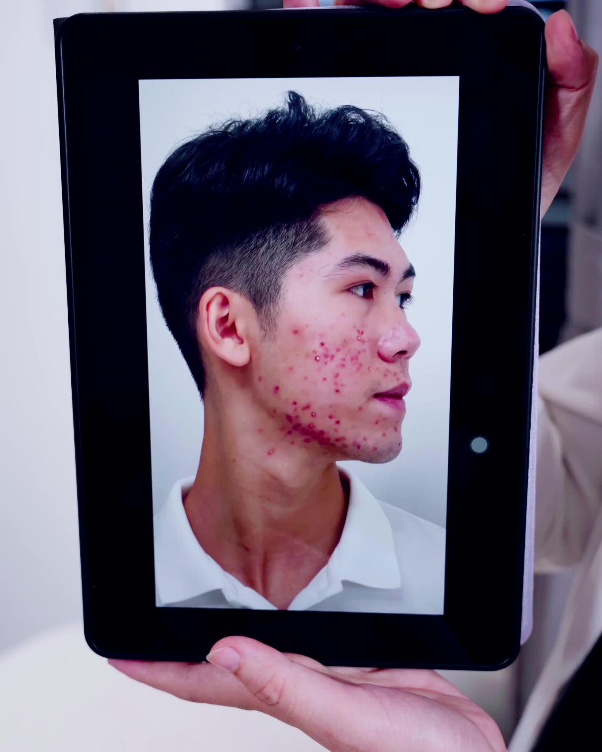 NHAN SẮC THĂNG HẠNG ''SOÁI CA'' CHỈ SAU 1 LIỆU TRÌNH TRỊ MỤN ACNE MEDIC