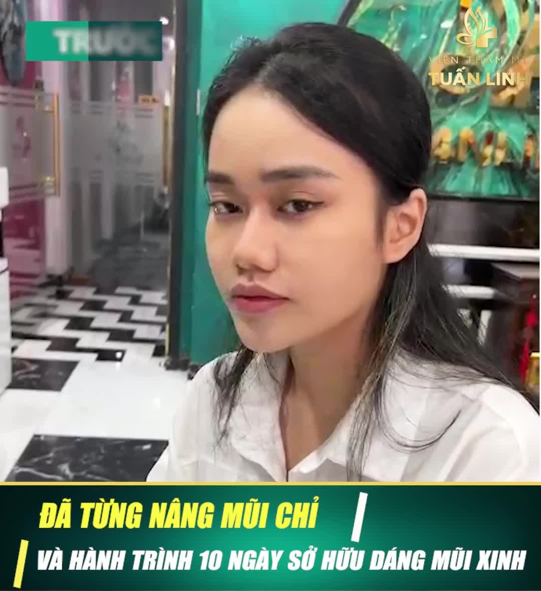 ĐÃ TỪNG SAI LẦM KHI NÂNG MŨI CHỈ VÀ HÀNH TRÌNH 10 NGÀY SỞ HỮU DÁNG MŨI XINH