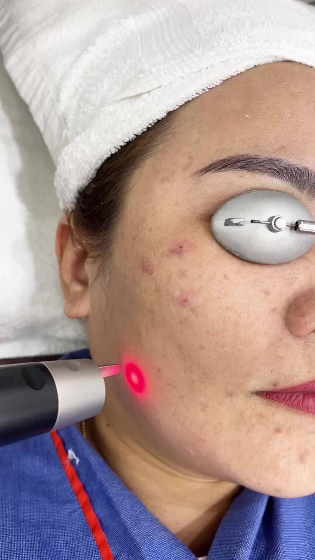 Điều trị nám hiệu quả với công nghệ Laser Picosue hiện đại bậc nhất thế giới