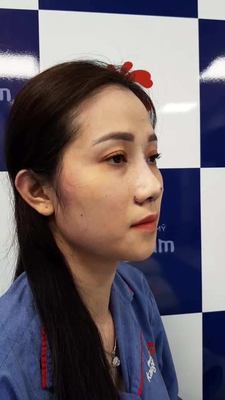 Nâng mũi Sline 6D Surgiform + Cắt cánh mũi  Đột phá công nghệ, trải nghiệm làm đẹp tuyệt vời!