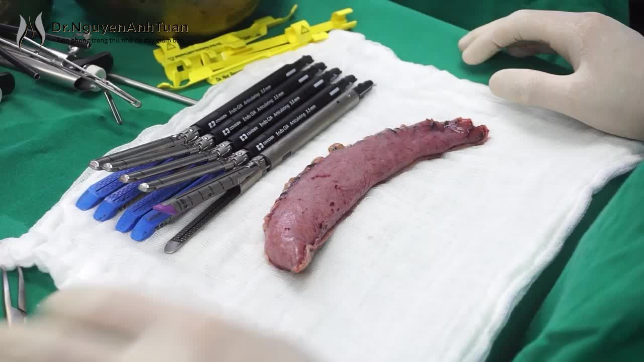 Phẫu thuật nội soi thu nhỏ dạ dày giảm béo là phương pháp loại bỏ khoảng 70 – 80% dạ dày theo phía bờ cong lớn