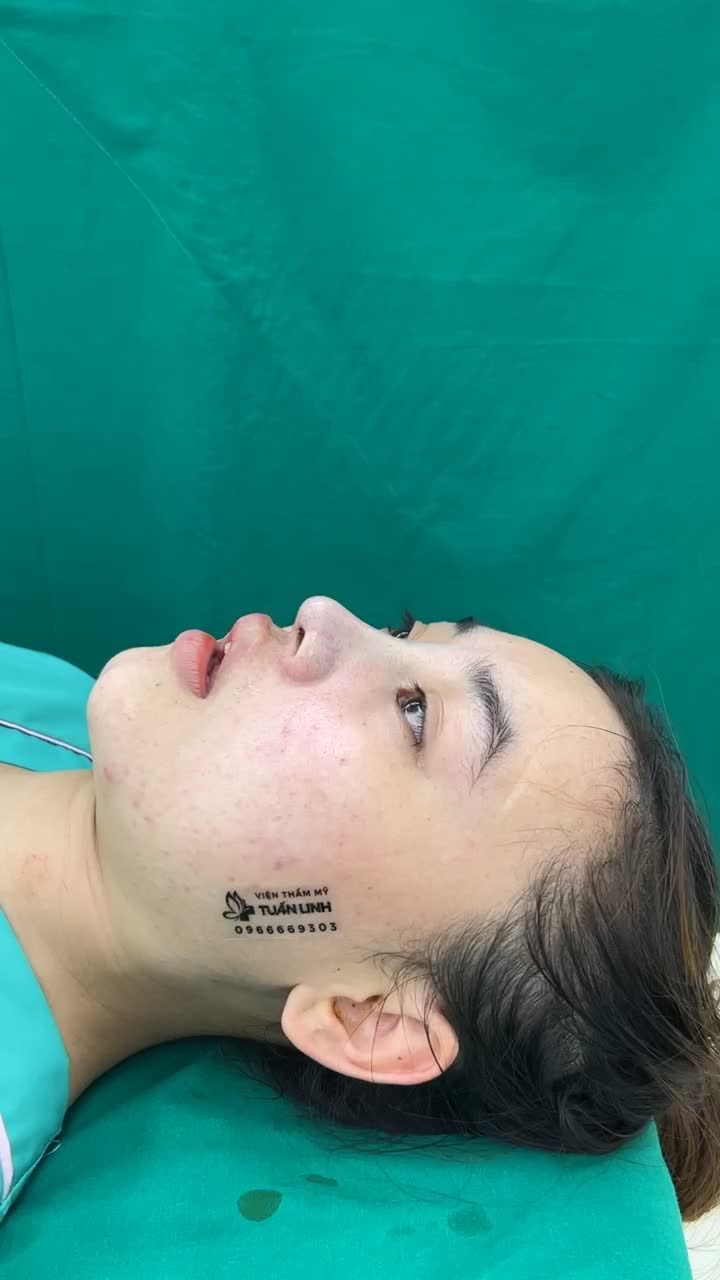 Bạn gái thích dáng mũi tự nhiên nên bác sĩ nhà Tuấn Linh làm hoàn toàn theo đúng yêu cầu của bạn, cực kỳ nhẹ nhàng tự nhiên nhưng vẫn rất thanh tú, tôn nét cho khuôn mặt.