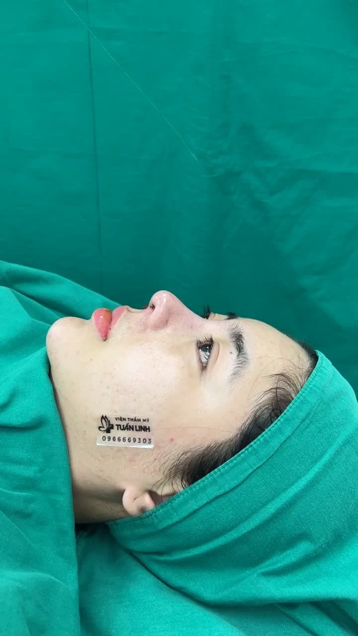 Case Nâng mũi siêu cấu trúc (mũi sửa lại) sử dụng sụn Surgiform cho chị gái đã từng nâng mũi cách đây 10 năm